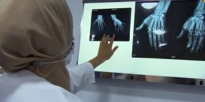 النساء أكثر عرضة له.. 30 بالمئة من الجزائريات مصابات بهشاشة العظام