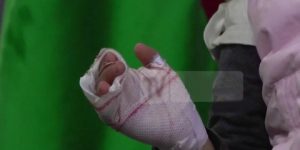 مختصون يحذرون من الحوادث المنزلية خاصة الحروق