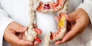 كيف يحافظ مريض القولون العصبي على صحته في رمضان؟