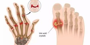التهاب المفاصل الروماتويدي.. مرض عضال يؤدي لتآكل المفاصل ويشوه جسم المريض