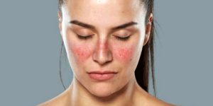 الذئبة الحمراء.. تحديات التشخيص والعلاج