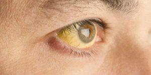 بينها التهاب الكبد والسرطان… حالات صحية تسبب اليرقان