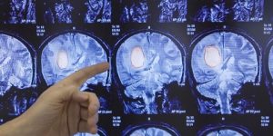 النتائج وُصِفَت بأنها “مذهلة”.. علاج جديد للحد من ورم في المخ يصيب الشباب