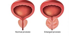المياه علاج لتضخم البروستات الحميد