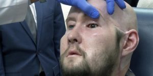 استمرت 21 ساعة.. إجراء أول جراحة بالعالم لزرع عين كاملة