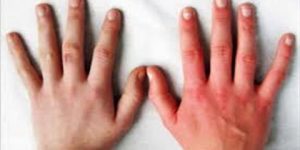 هل تعاني من تورم الأصابع في الشتاء؟.. إليك الأسباب والعلاج