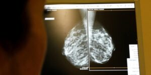 أعراض شائعة قد تشير لسرطانات تصيب النساء