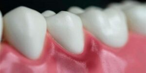 جديد الطب.. ابتكار دواء جديد لعلاج التهاب اللثة