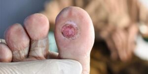 أخبار الصحة.. خوفًا من بتر القدمين- هكذا يمكن علاج غرغرينا السكري