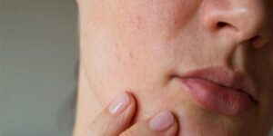 أسباب احمرار الخدود المفاجئ.. خجل أم مشكلة صحية؟