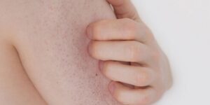 نصائح جمالية.. علاج جلد الإوزة بطرق طبية ومنزلية