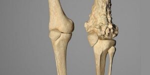 “الساركوما” …أكثر من 70 نوعا فرعيا مختلفا