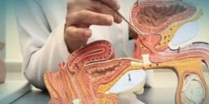 التهاب المثانة.. مرض ينشط خلال فصل الصيف