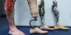 دراسة حديثة تقول.. آلام الأطراف المبتورة يُمكن تخفيفه بهذه الطريقة