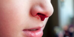 حشوة الأنف لحالات الرعاف.. متى يُصبح استعمالها مفيدا؟