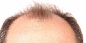 نحو تحقيق حلم الكثيرين.. تليين الخلايا الجذعية للبصيلات تنتج الشعر