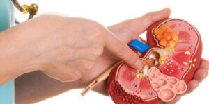 دراسة جديدة تكشف.. أدوية السكري تخفّض خطر الإصابة بحصوات الكلى والنقرس