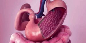 “بوتكس المعدة”.. أحدث تقنية في هذا المجال