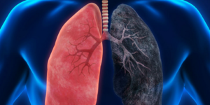 سرطان الرئة.. الأسباب وطرق الوقاية