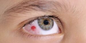 بقعة حمراء وسط بياض العين.. كل ما عليك معرفته عنها