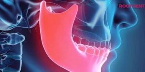 أورام الفكين… كيفية التشخيص وسُبل العلاج