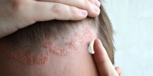 الإكزيما الدهنية.. أهم أسبابها وسبل علاجها