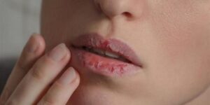 ضرورية في هذه الفترة من السنة.. الطريقة الصحيحة للعناية بالشفاه