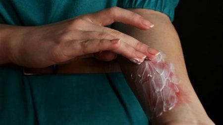 خدعوك فقالوا.. معجون الأسنان يخفف ألم الحروق الجلدية