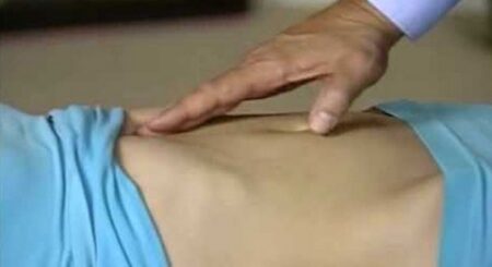 فتحة غير طبيعية تعقد حياة الإنسان.. ملخص شامل عن الفتق “البعج”