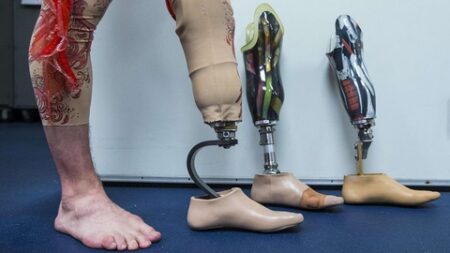دراسة حديثة تقول.. آلام الأطراف المبتورة يُمكن تخفيفه بهذه الطريقة