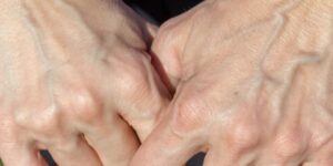 انتفاخ العروق.. أسباب وطرق العلاج