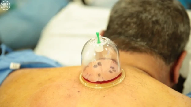 نطالب بإنشاء مركز وطني للطب التكميلي في الجزائر وتقنين ممارسة الحجامة