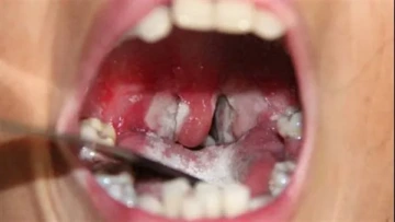 ماذا تعرف عن مرض الدفتيريا أو “الخناق”؟